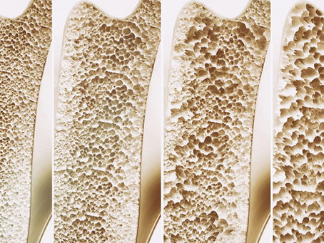 Osteoporoz Nedir?