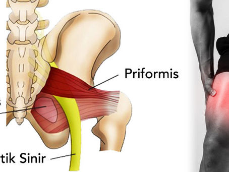 Siyatik - Priformis Sendromu