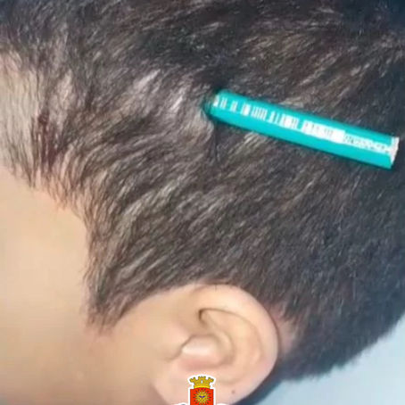 Menino fica com lápis alojado na cabeça após ser agredido por colega em escola de Praia Grande.