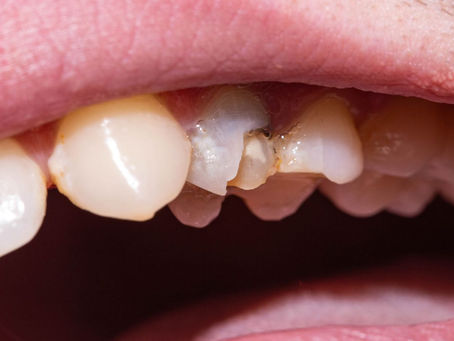 How Long Does Tooth Restoration Last?