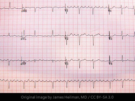 Atrial Flutter