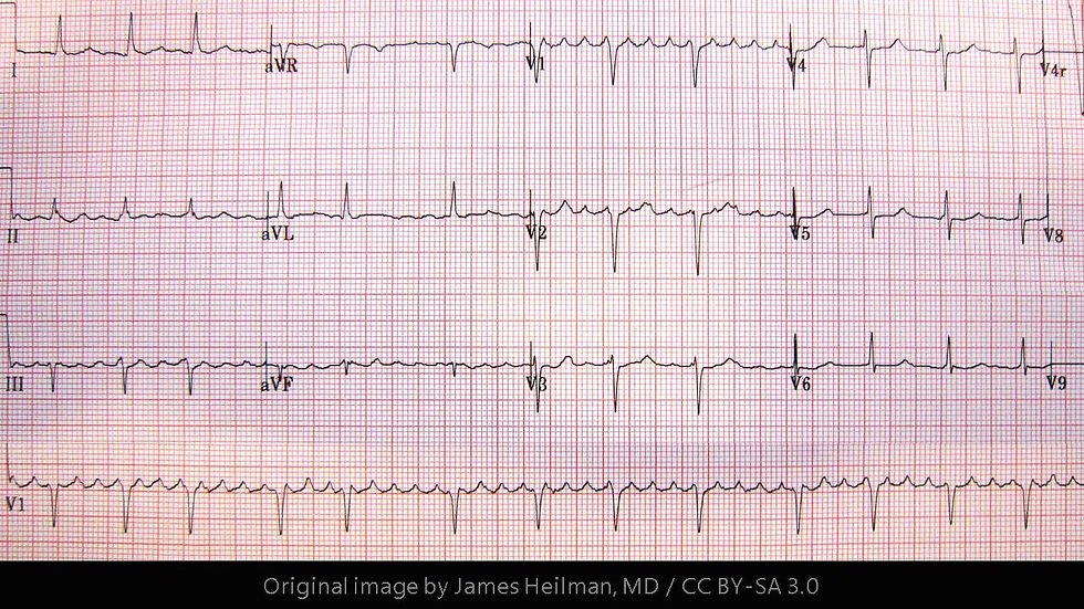 Atrial Flutter
