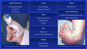 Trisomy 18: Dysmorphic Features.jpeg