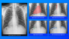 Situs Inversus - Chest x-ray.jpg