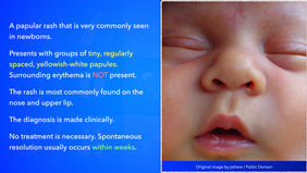 Sebaceous Gland  Hyperplasia  .001.jpeg