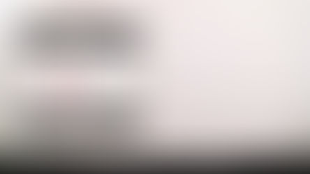 Left Bundle Branch Block (LBBB)