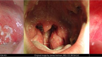 Streptococcal Pharyngitis