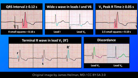  ECG right bundle branch block rbbb usmle.001.jpeg