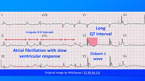 Hypothermia ecg.jpg