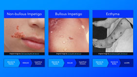 Impetigo Subtypes.jpg