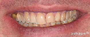 Analyse esthétique et projection du nouveau sourire