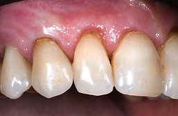 Récession gingivale, déchaussement des dents, Dentiste, Toulouges, Perpignan, 66
