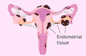 Endometriosis Homeopathic doctor in Chennai