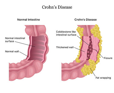 Homeopathy Doctor for Crohn's Disease in Chennai