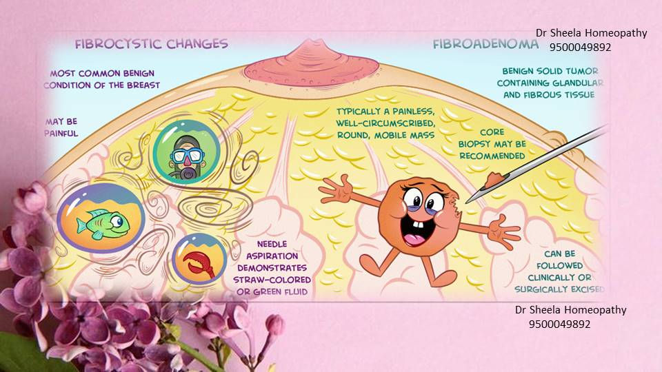 Fibroadenoma of breast homeopathy doctor in chennai