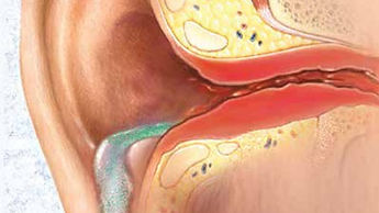 Homeopathy Treatment For Ear Infection