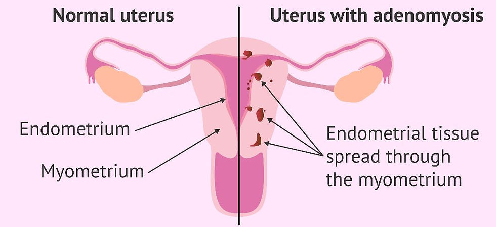 Adenomyosis Homeopathy Treatment in Chennai