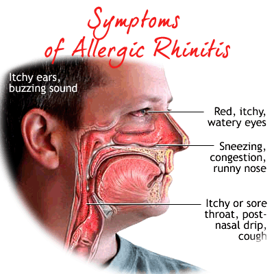 allergic-Rhinitis Treatment - Dr. Sheela Homeopathic Healthcare Clinic