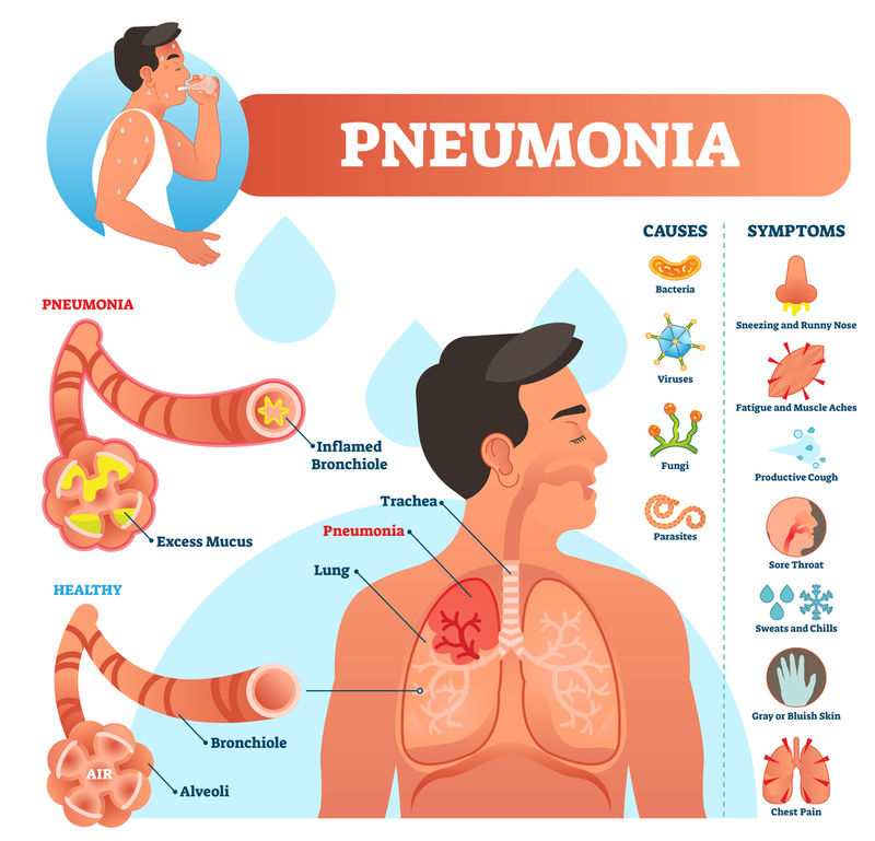 Pneumonia Homeopathy Clinic in Chennai