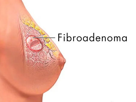 Fibroadenoma of Breast Homeopathy Treatment in Chennai