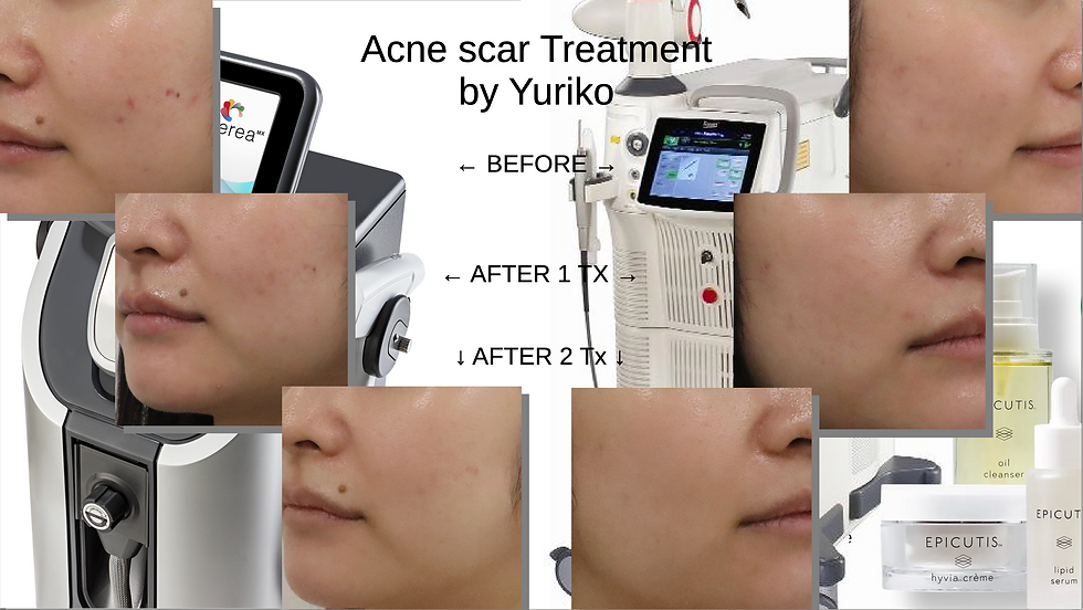 Acne scar treatment
