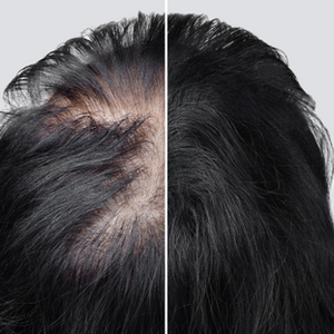 Alopecias - Queda de Cabelo