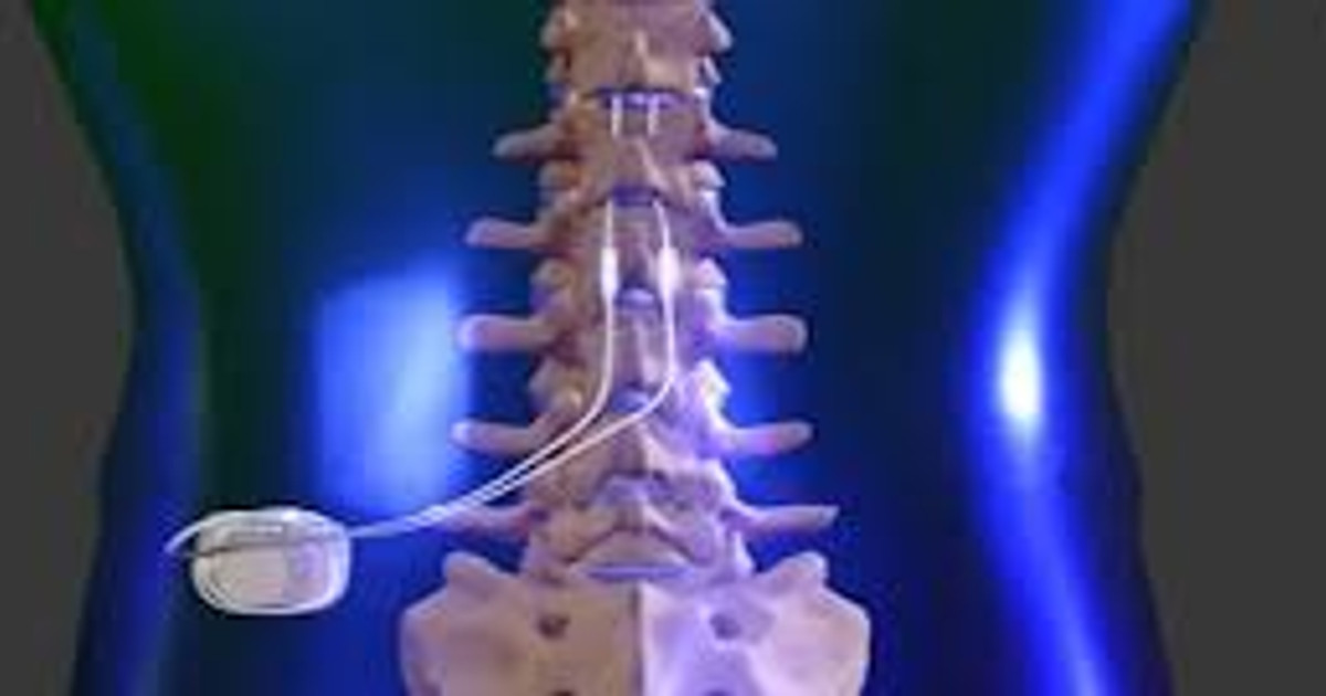 A pain specialist explaining advanced pain management options to a patient using a model of an implanted spinal cord stimulator.