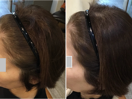 ◆「ヒト幹細胞施術例」練馬髪質改善トリートメント&エイジングヘアケア・ヘッドスパ練馬専門サロン/練馬美容室、美容院シフィ(sihui)