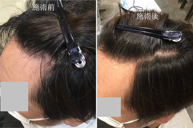 ◆「発毛育毛コース」練馬髪質改善トリートメント＆エイジングヘアケア・ヘッドスパ練馬専門サロン/練馬美容室、練馬美容院シフィ(sihui)