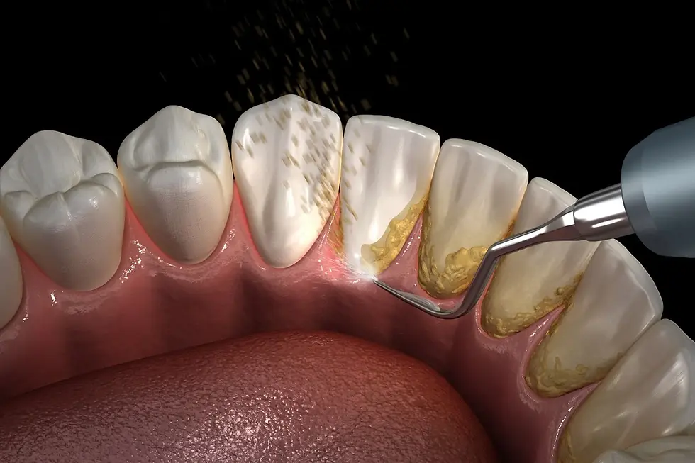 A closeup picture of the process of teeth cleaning