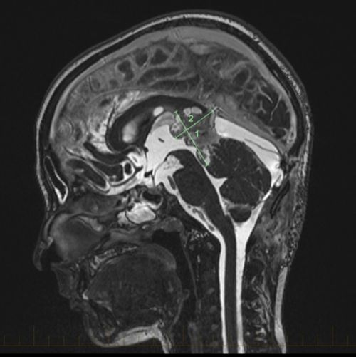MRI scan of a human head in profile, showing brain structure with marked measurements. Black and gray tones dominate.