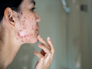 A woman with cystic acne looking at the mirror. She is touching her acne with her fingers.Acne looks reddish and is spread all over her face with a lot on the chin and jawline.