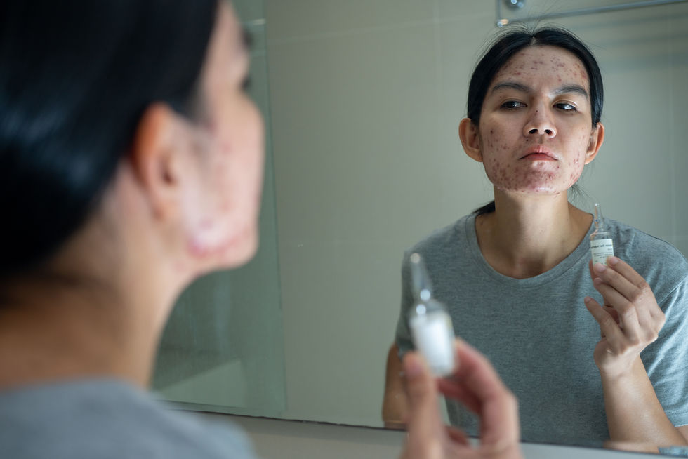 Woman with acne studies her face in a bathroom mirror while holding a small skincare bottle, looking serious and concerned.