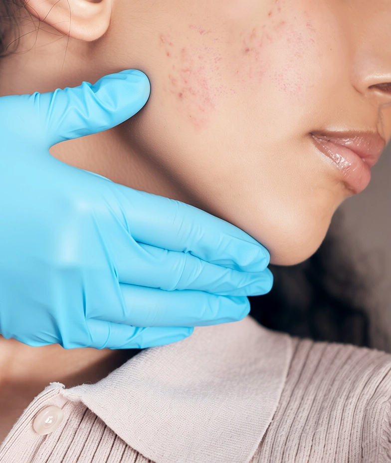 Gloved hand examining cheek acne for acne treatment in Singapore at The Acne Clinic in i12 Katong.