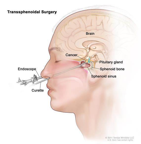 Diagram of transsphenoidal surgery showing tools accessing a brain via the nose. Labels indicate brain, pituitary gland, cancer, bone.