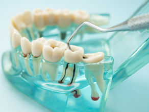 Root Canal Treatment: What to Expect and When It May Be Needed
