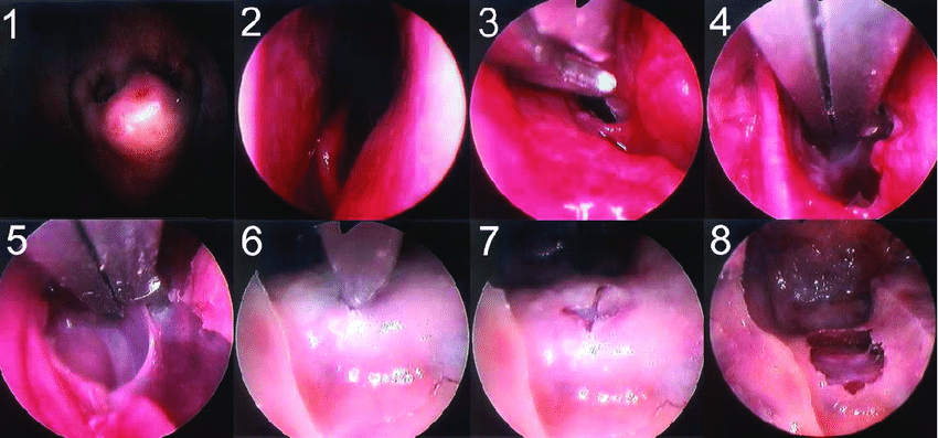 Eight close-up medical images of laryngeal surgery steps, showing pink tissues. Each frame is numbered 1 to 8, depicting gradual incision.