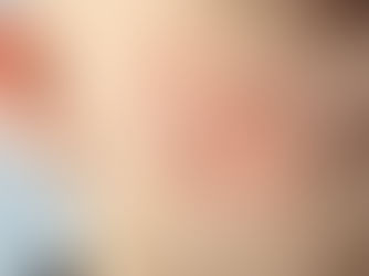 How TCA CROSS Helps Smooth and Refine Acne Scars