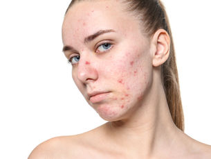 Cystic Acne Keeps Coming Back: What Could Be Triggering It