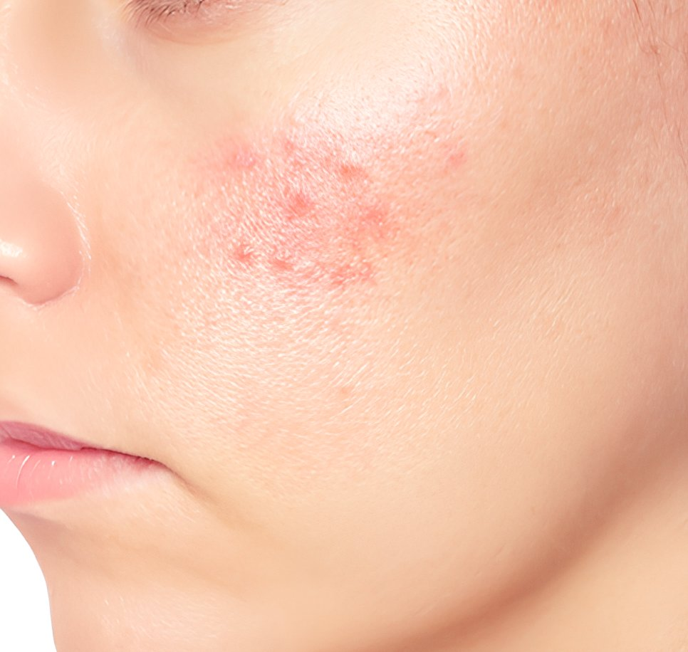 Close-up of facial redness and acne-like bumps associated with rosacea