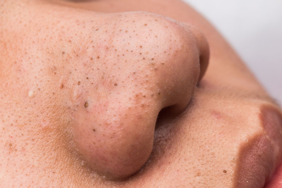 Close-up of a freckled nose and cheek in soft light, showing skin texture against a plain background