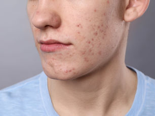 Close-up of a person's cheek showing acne blemishes. The background is gray, and they're wearing a light blue shirt. No text visible.