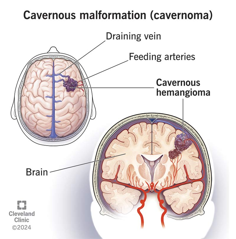 Illustration depicting a brain with labels: cavernous malformation, draining vein, and feeding arteries. Includes Cleveland Clinic logo.