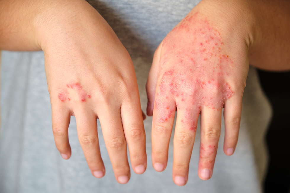 Close-up of two hands showing eczema symptoms. The left hand has a small patch of red, inflamed skin, while the right hand displays widespread redness, dryness, and raised bumps typical of moderate-to-severe eczema.