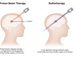 Proton Therapy, For Brain, Spine Cancer & Tumours