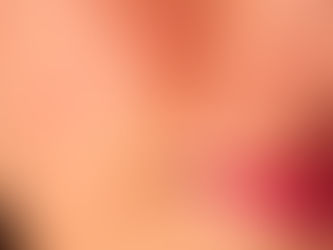 Close-up of a person's face showing skin texture and whiteheads near the nose and lips. Warm lighting highlights redness and blemishes.