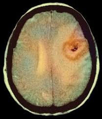 A brain CT scan shows a circular, dark lesion on the right side. The image has a mix of light and dark colors on a black background.