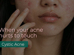 When Your Acne Hurts, It Is Telling You Something Different. Could it be Cystic Acne?