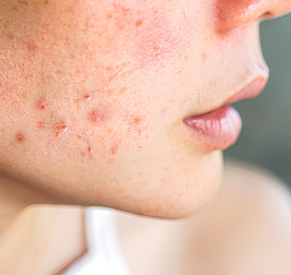 Inflammatory Acne