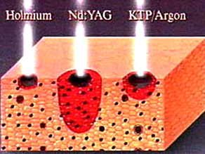 Laser Spine Surgery and No Surgery Laser and Super (Superior to Laser) Procedures